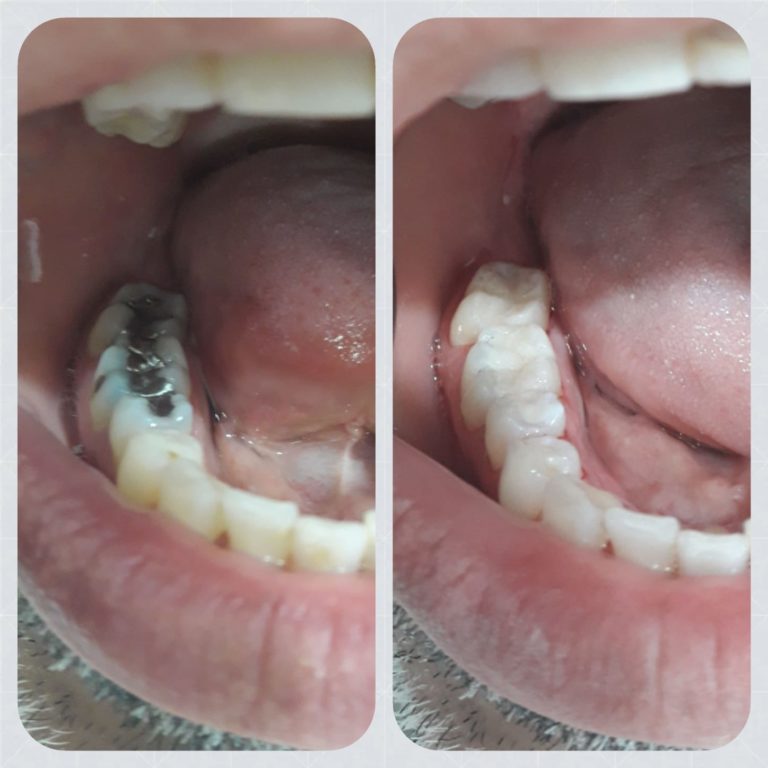 amalgam replacement before and after