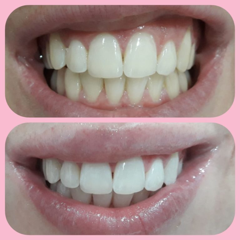 teeth whitening before and after