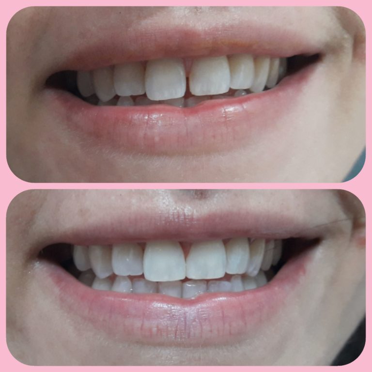 before and after direct composite venner